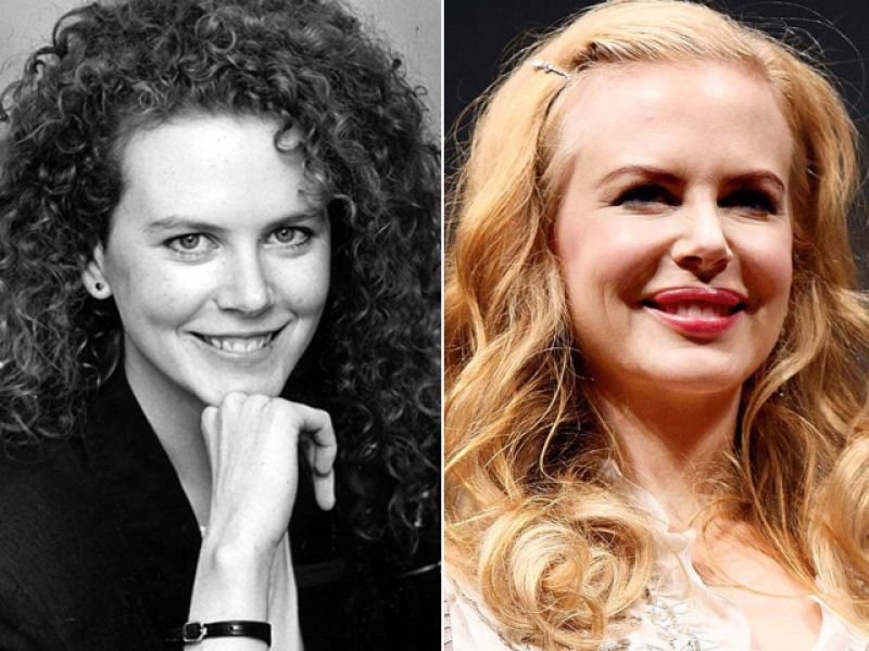 Unveiling The Truth Nicole Kidman And Botox